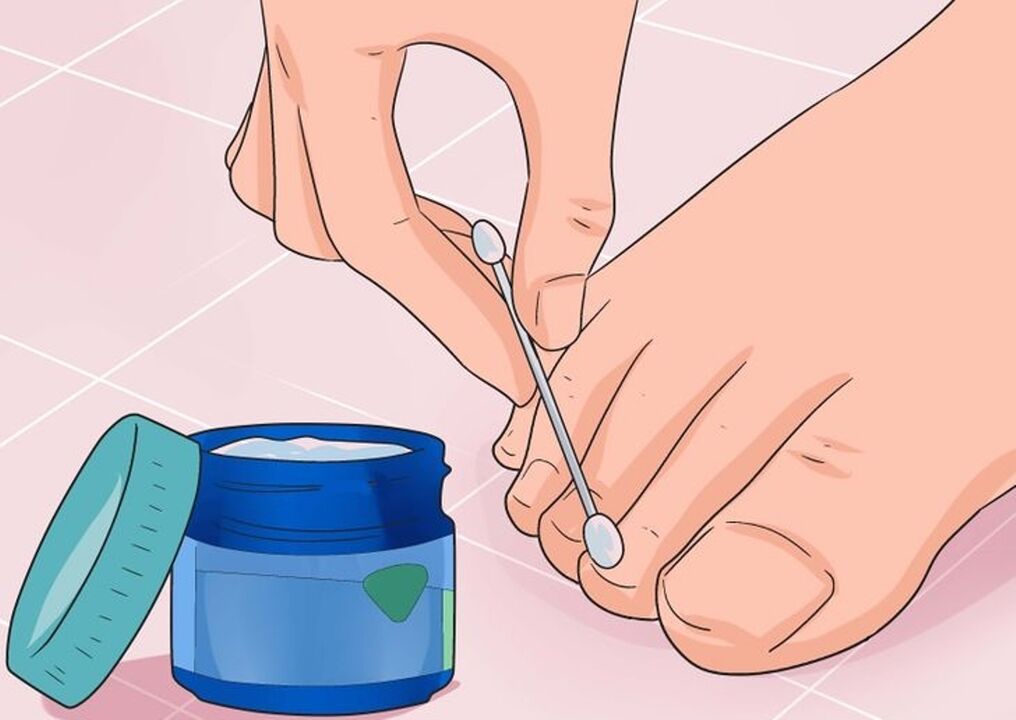 Cura il fungo delle unghie