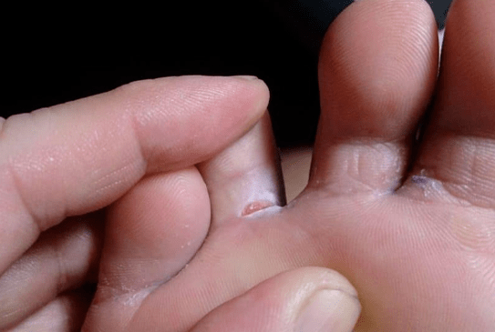 L'aspetto di formazioni di bolle sui piedi