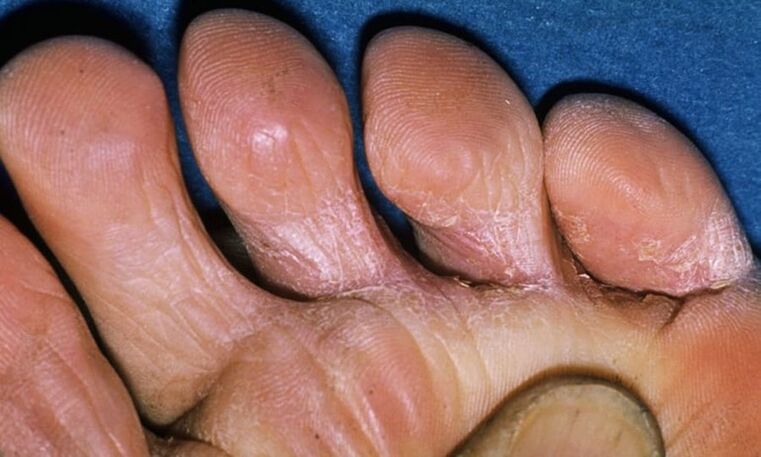 Vari tipi di fungo delle gambe