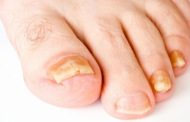 unghie dei piedi gialle a causa di funghi