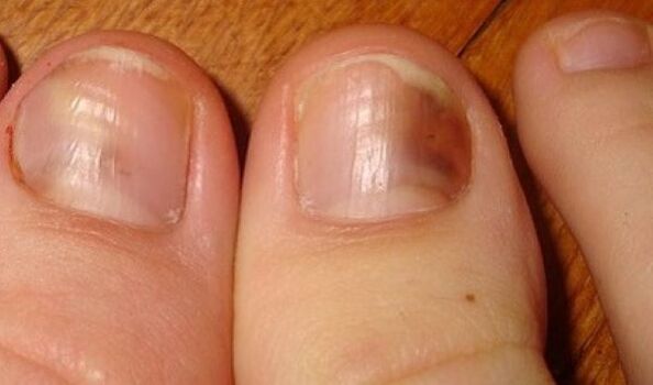 unghie colpite da funghi