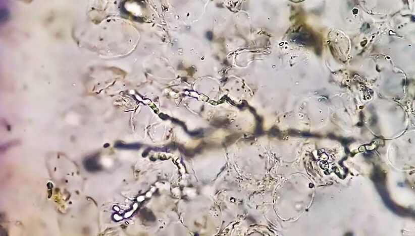 Funghi al microscopio – il colpevole dello sviluppo della micosi dei piedi